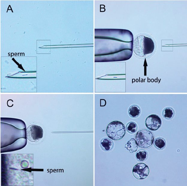 Intracytoplasmic Sperm Injection Procedure
