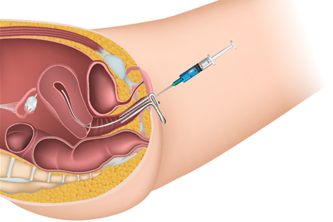 IUI process